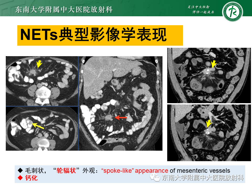 影像PPT - 【PPT】病例讨论：小肠恶性肿瘤-49