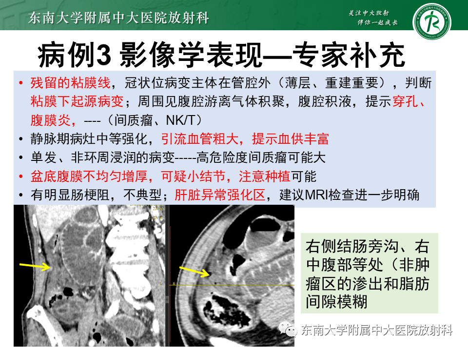 影像PPT - 【PPT】病例讨论：小肠恶性肿瘤-26