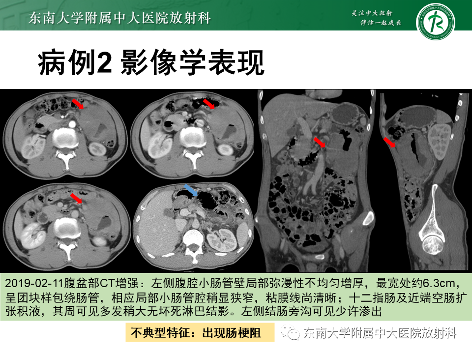 影像PPT - 【PPT】病例讨论：小肠恶性肿瘤-21