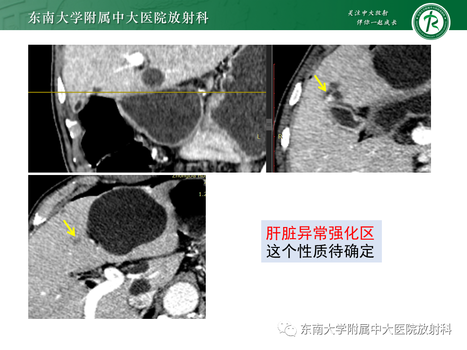影像PPT - 【PPT】病例讨论：小肠恶性肿瘤-28