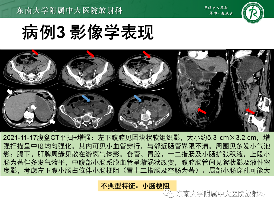 影像PPT - 【PPT】病例讨论：小肠恶性肿瘤-25