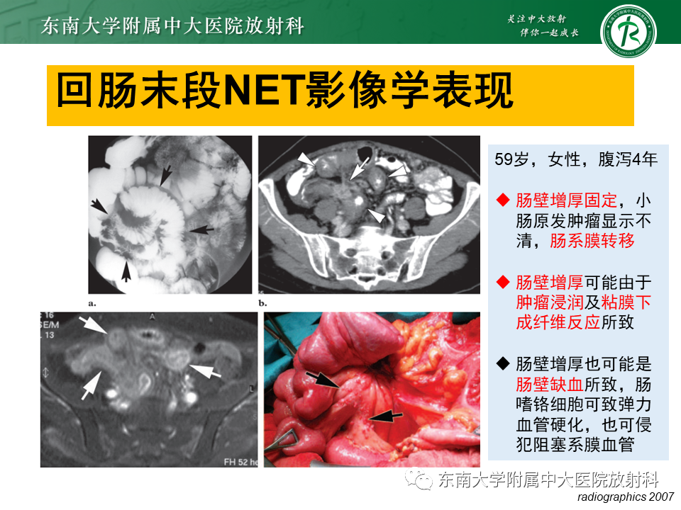 影像PPT - 【PPT】病例讨论：小肠恶性肿瘤-50