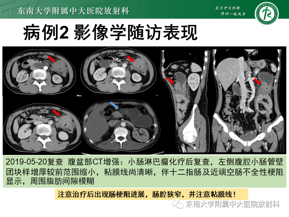 影像PPT - 【PPT】病例讨论：小肠恶性肿瘤-24