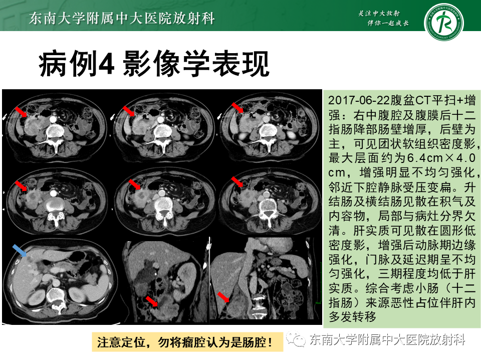 影像PPT - 【PPT】病例讨论：小肠恶性肿瘤-31