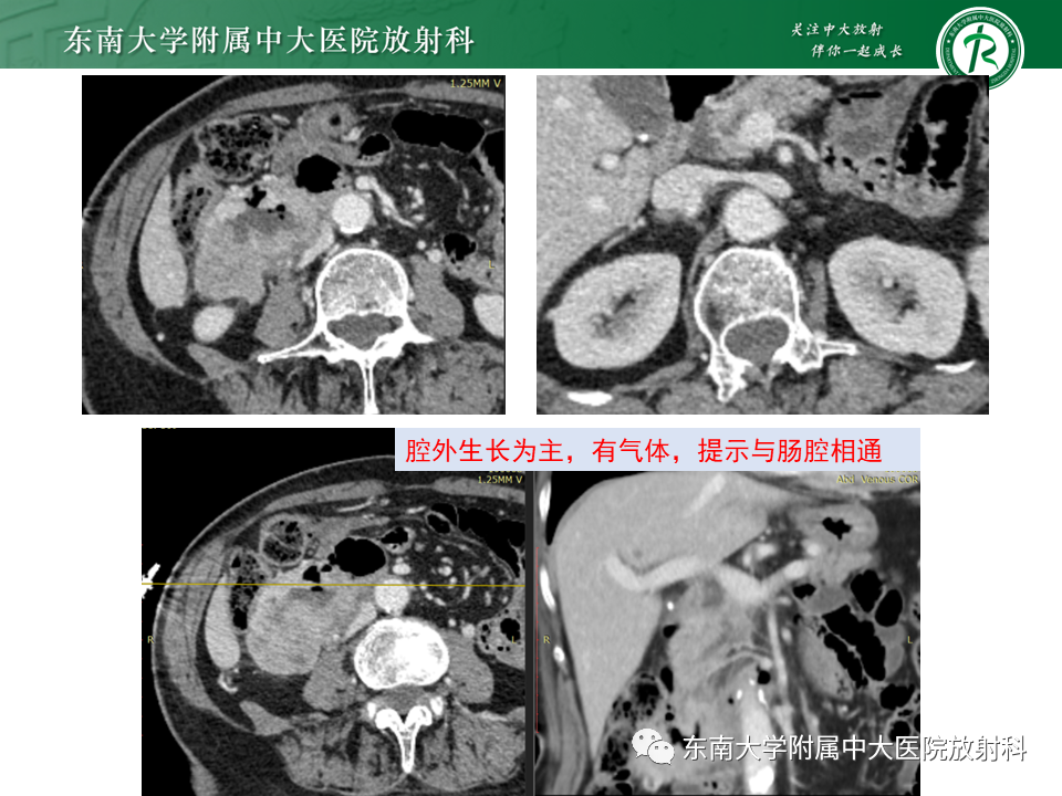 影像PPT - 【PPT】病例讨论：小肠恶性肿瘤-33