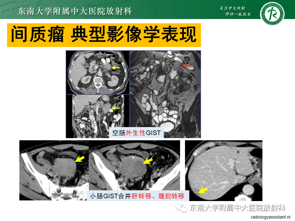影像PPT - 【PPT】病例讨论：小肠恶性肿瘤-46
