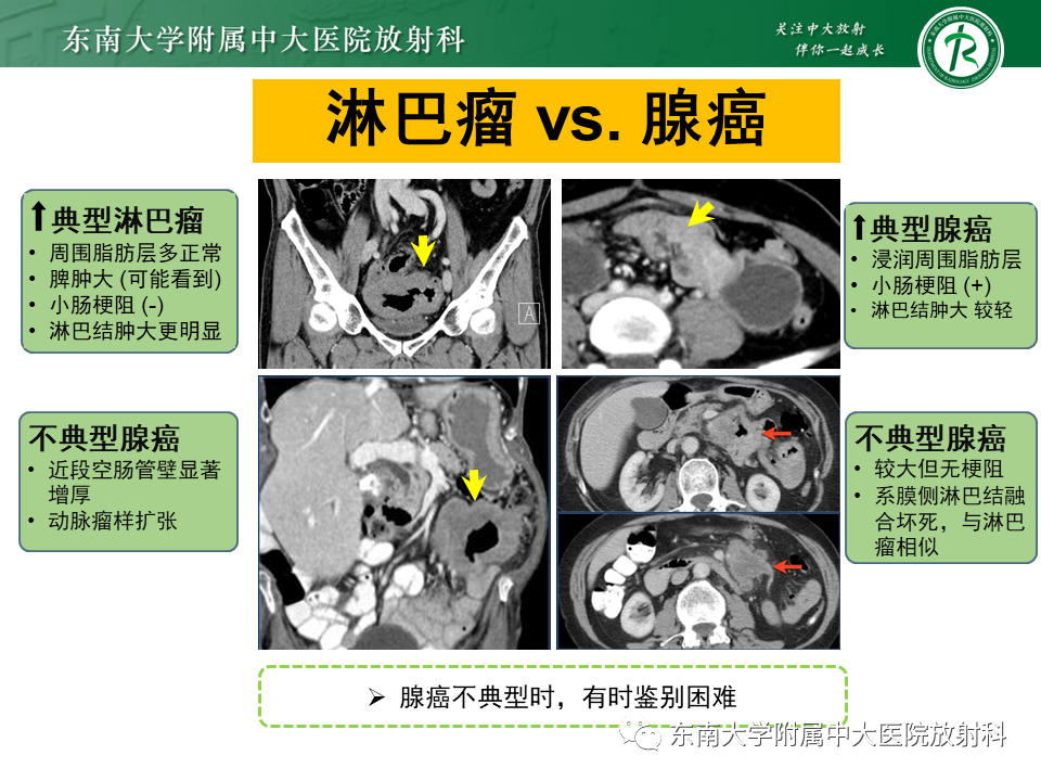 影像PPT - 【PPT】病例讨论：小肠恶性肿瘤-43