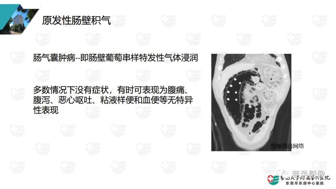 影像PPT - 【PPT】肠壁积气-13