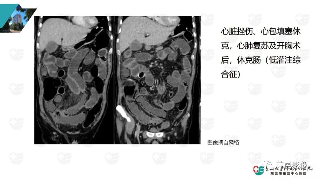 影像PPT - 【PPT】肠壁积气-16