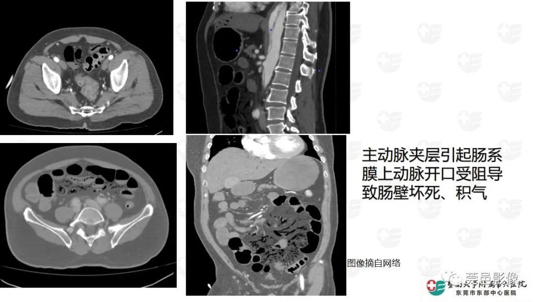影像PPT - 【PPT】肠壁积气-17
