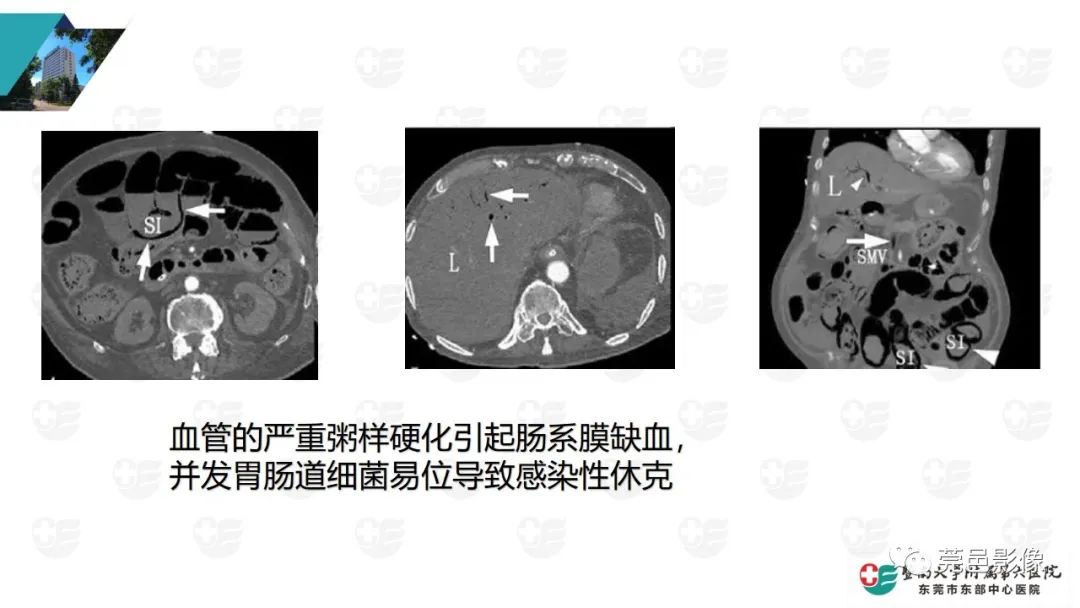 影像PPT - 【PPT】肠壁积气-18