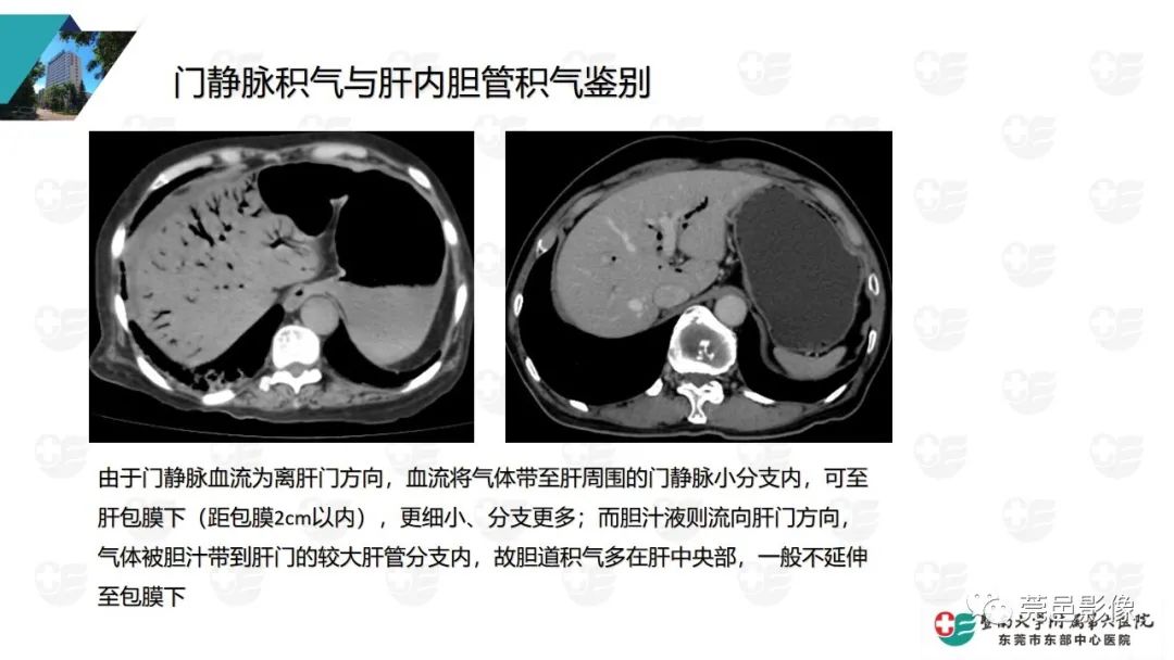 影像PPT - 【PPT】肠壁积气-20