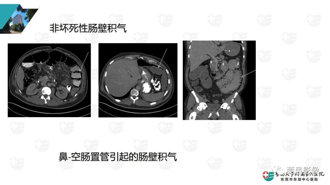影像PPT - 【PPT】肠壁积气-24