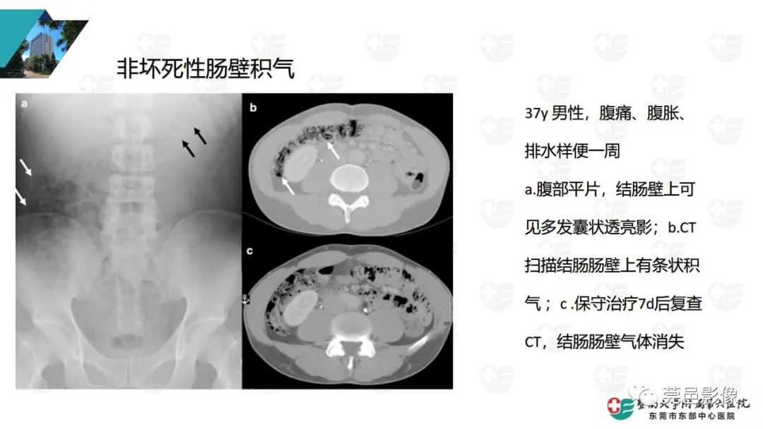 影像PPT - 【PPT】肠壁积气-22