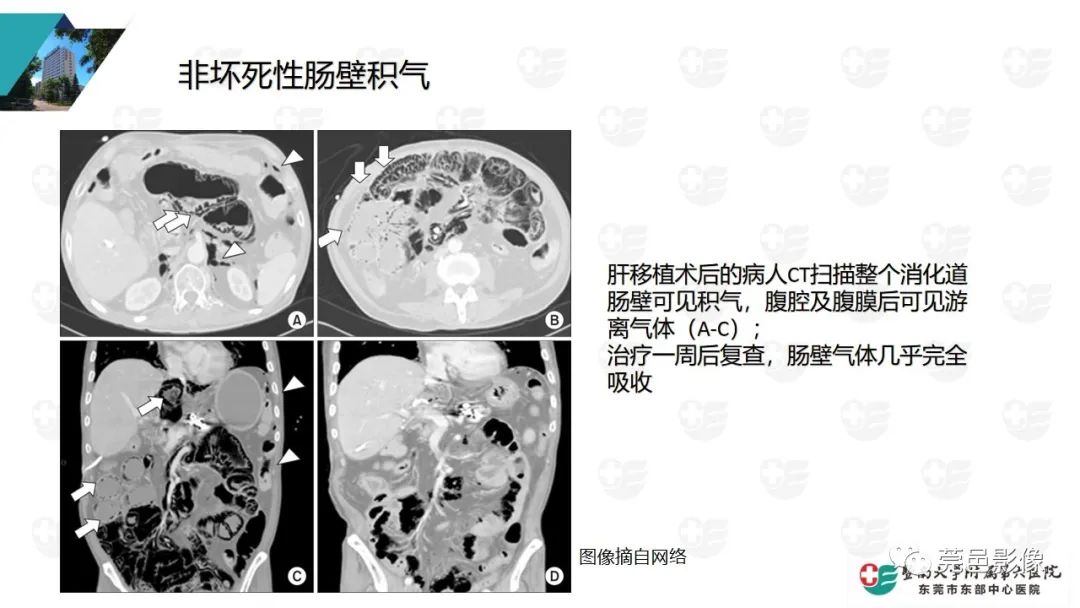 影像PPT - 【PPT】肠壁积气-23