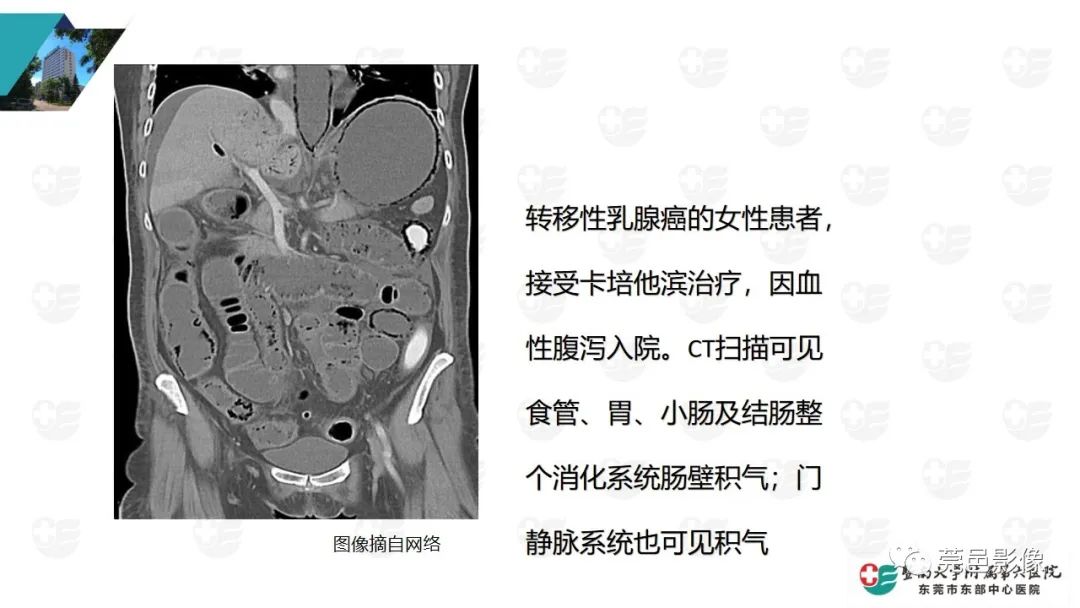 影像PPT - 【PPT】肠壁积气-25