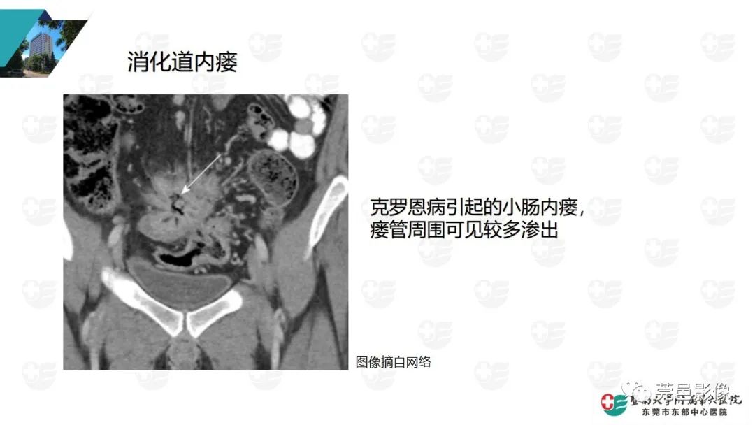 影像PPT - 【PPT】肠壁积气-31
