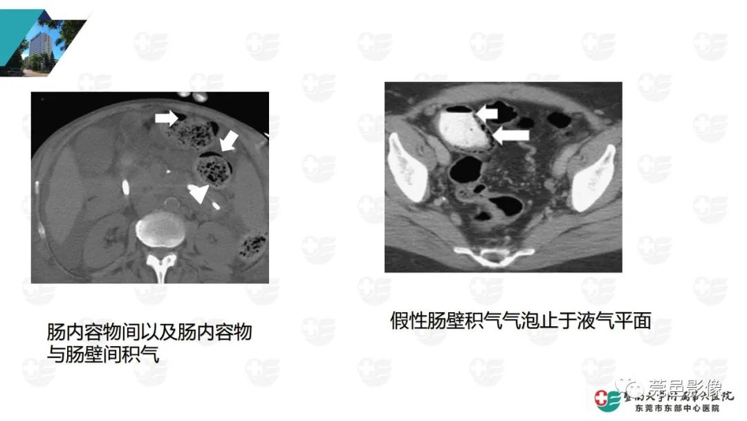 影像PPT - 【PPT】肠壁积气-29