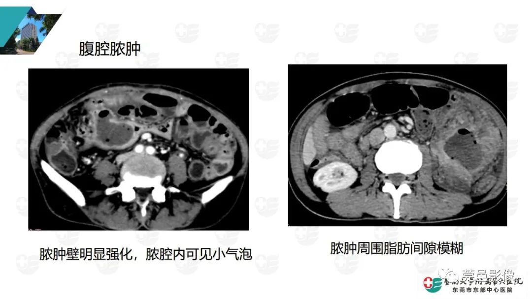 影像PPT - 【PPT】肠壁积气-33