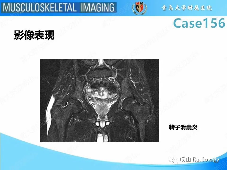 影像PPT - 【PPT】臀中肌及臀小肌肌腱撕裂-21