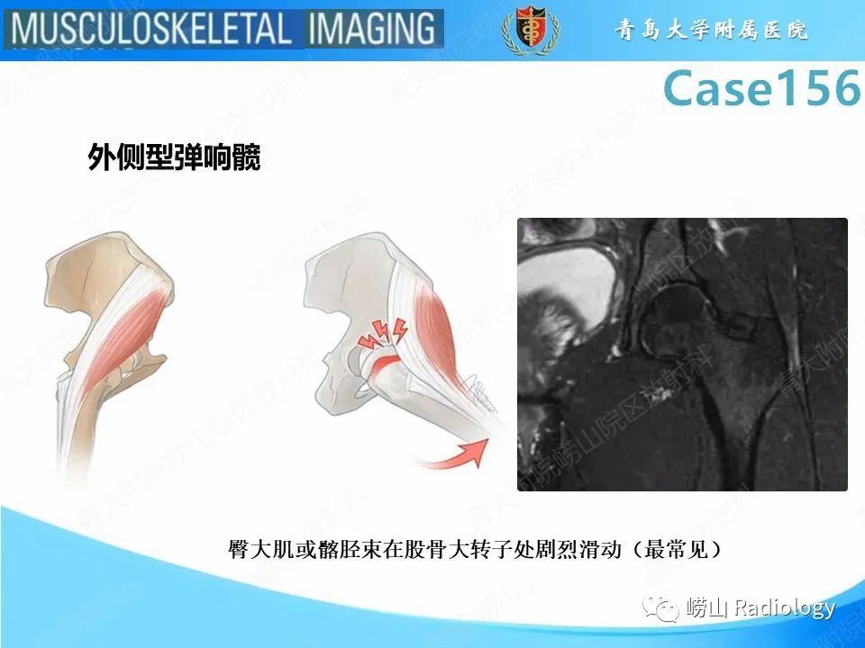 影像PPT - 【PPT】臀中肌及臀小肌肌腱撕裂-23