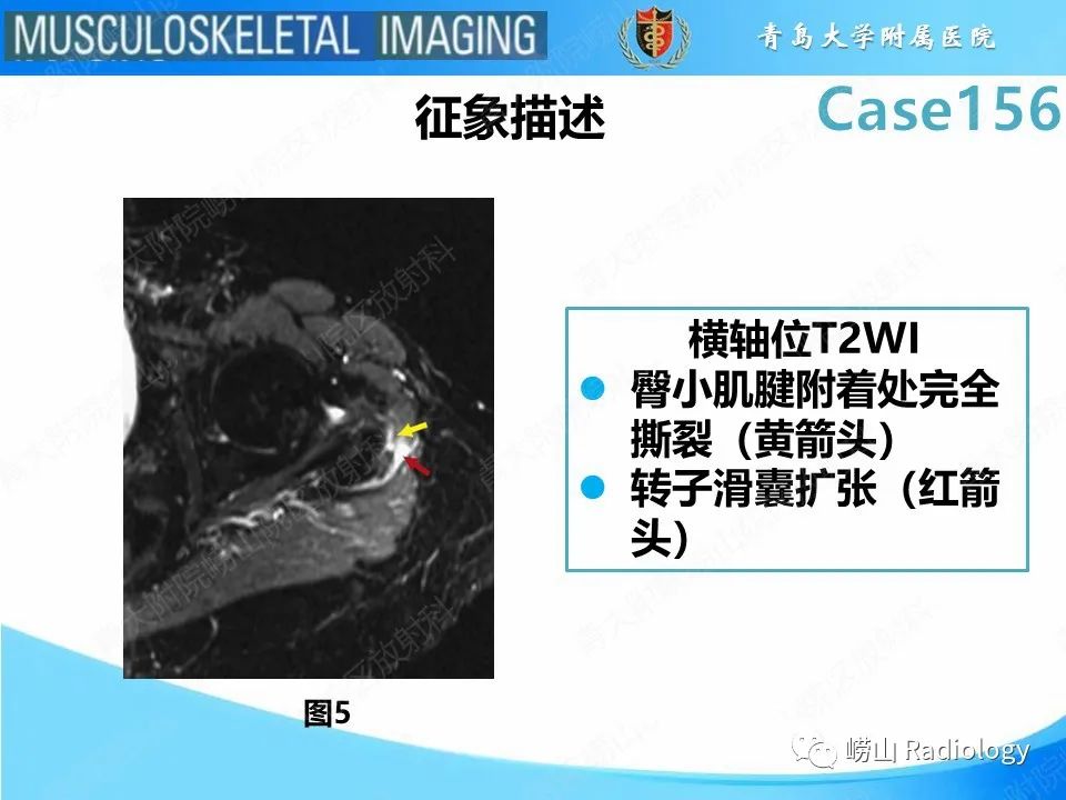影像PPT - 【PPT】臀中肌及臀小肌肌腱撕裂-15