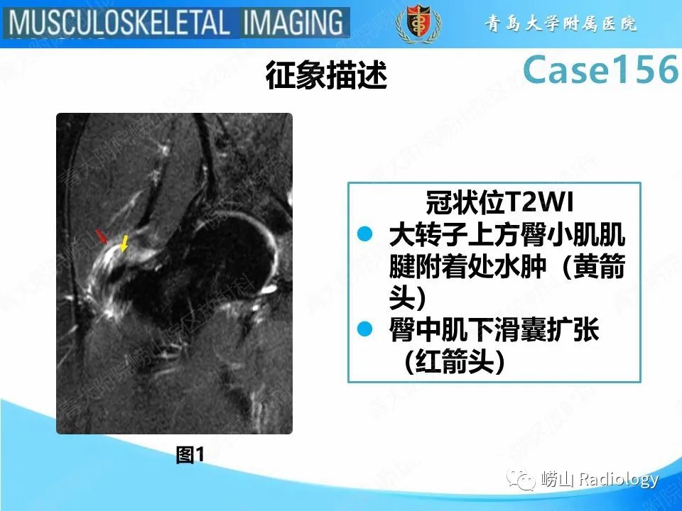 影像PPT - 【PPT】臀中肌及臀小肌肌腱撕裂-11