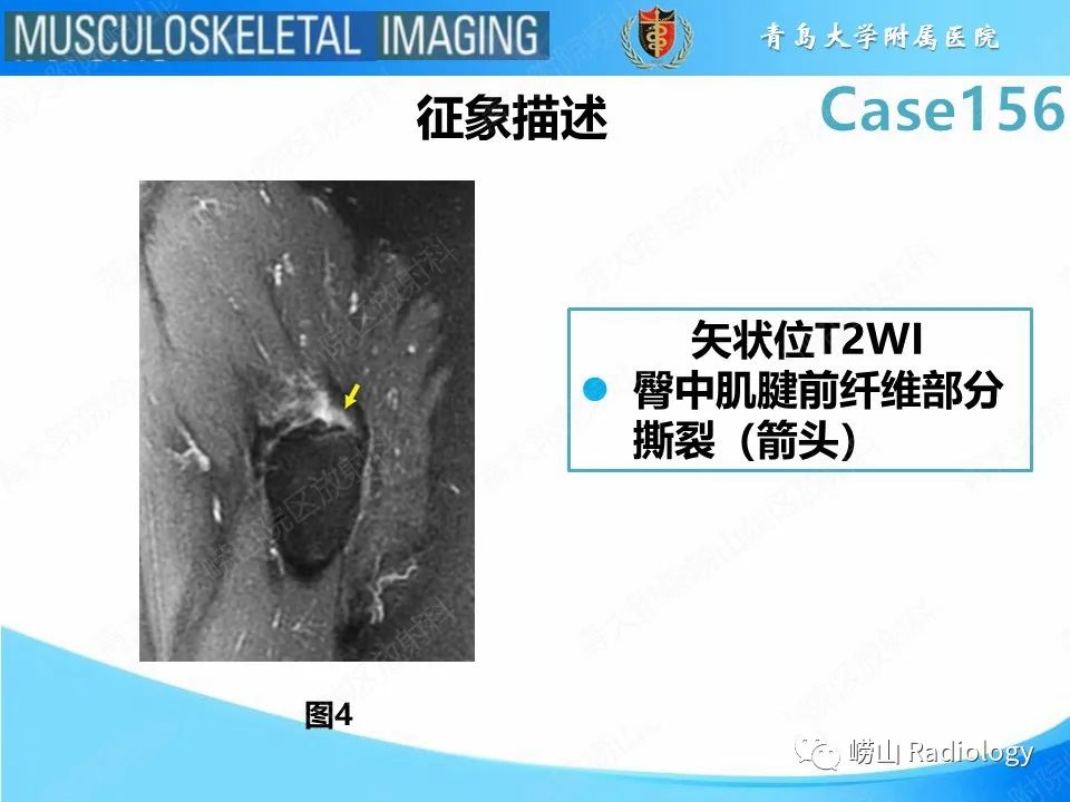 影像PPT - 【PPT】臀中肌及臀小肌肌腱撕裂-14
