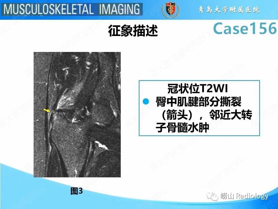 影像PPT - 【PPT】臀中肌及臀小肌肌腱撕裂-13