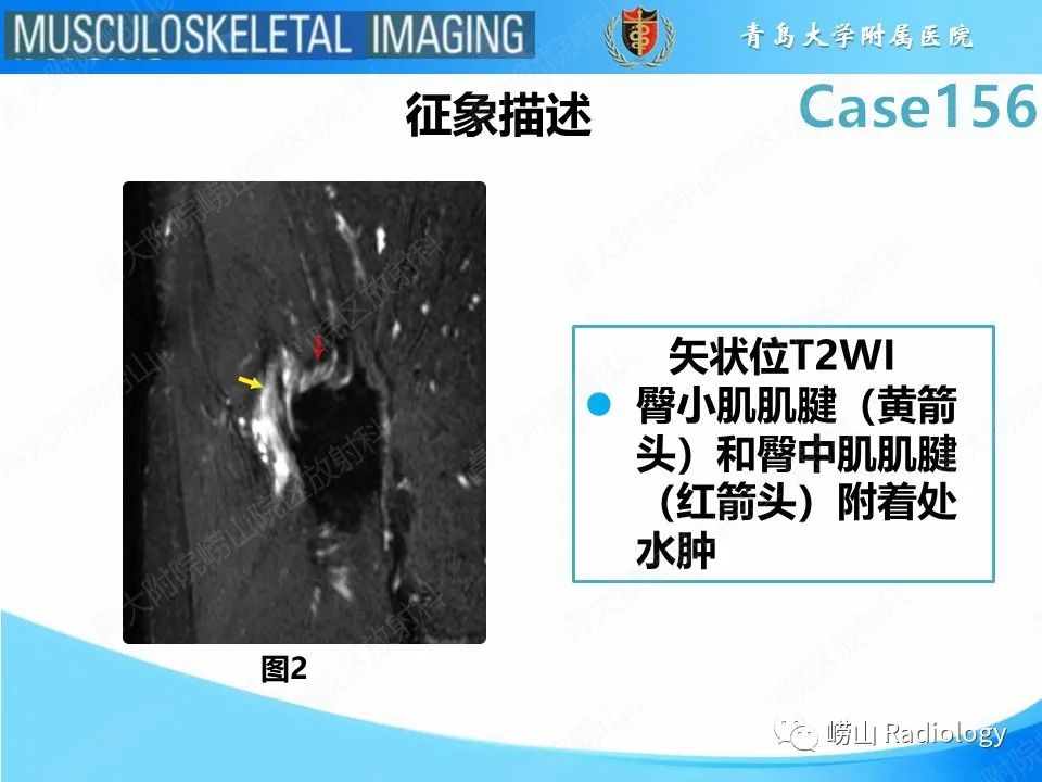 影像PPT - 【PPT】臀中肌及臀小肌肌腱撕裂-12