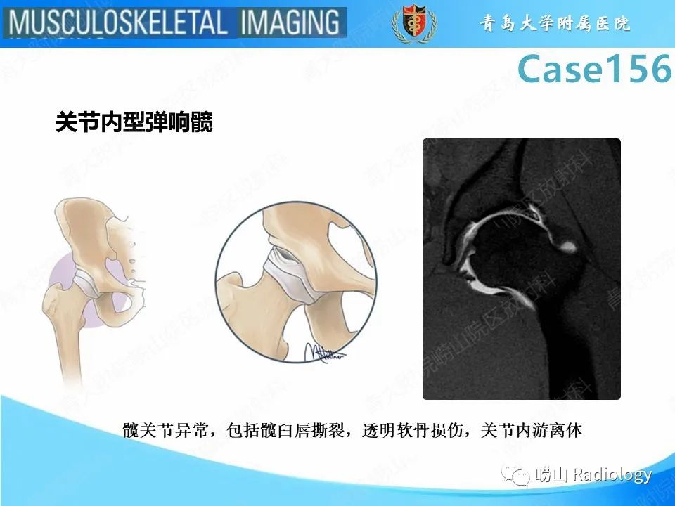 影像PPT - 【PPT】臀中肌及臀小肌肌腱撕裂-25