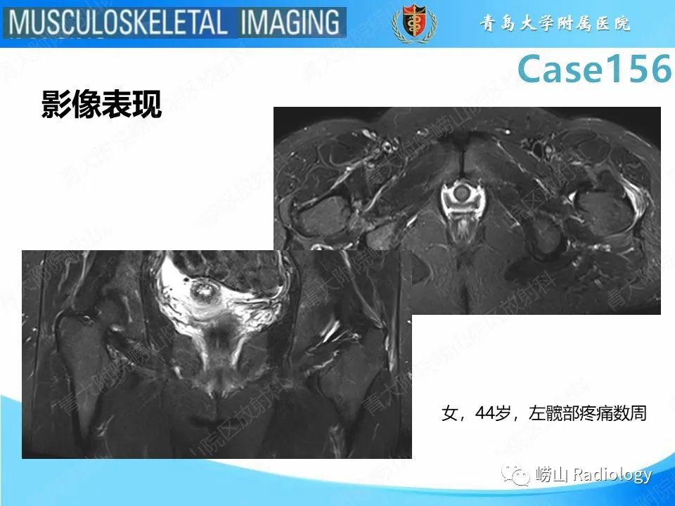 影像PPT - 【PPT】臀中肌及臀小肌肌腱撕裂-20