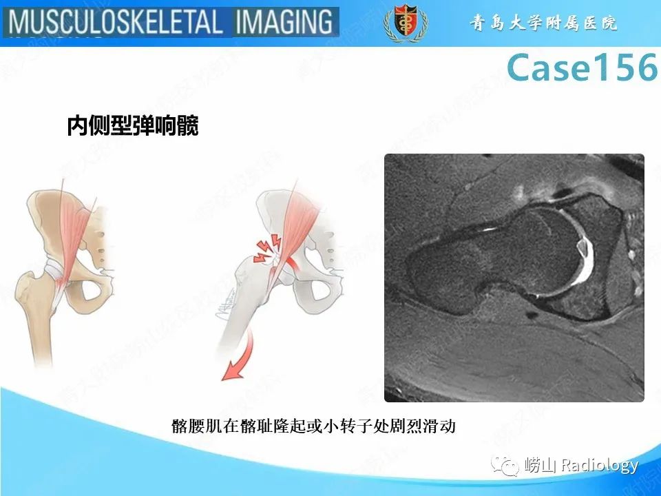 影像PPT - 【PPT】臀中肌及臀小肌肌腱撕裂-24