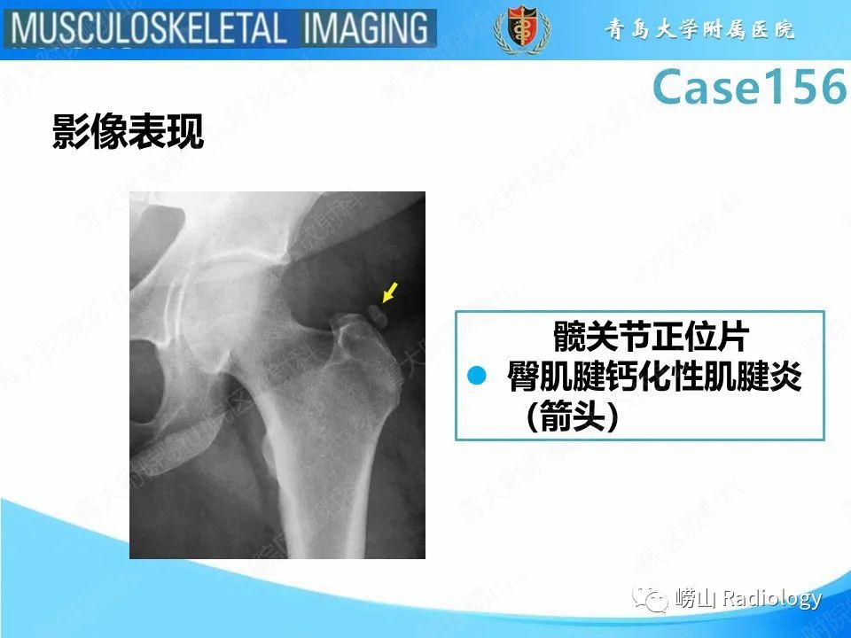 影像PPT - 【PPT】臀中肌及臀小肌肌腱撕裂-27