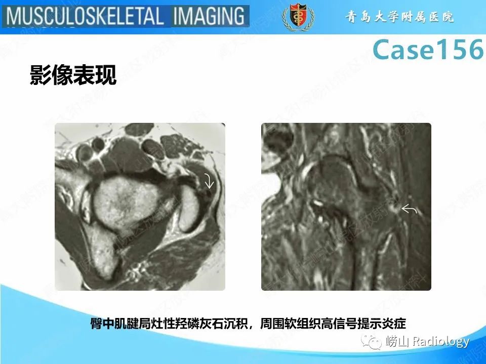 影像PPT - 【PPT】臀中肌及臀小肌肌腱撕裂-28