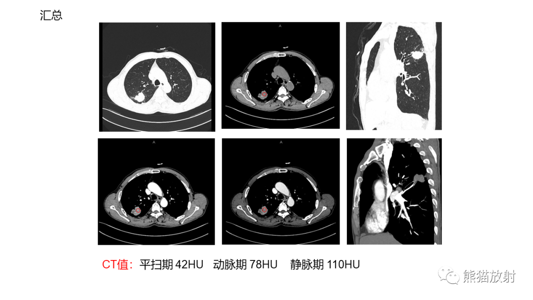 影像PPT - 【病例】肺大细胞神经内分泌癌2例CT影像-7