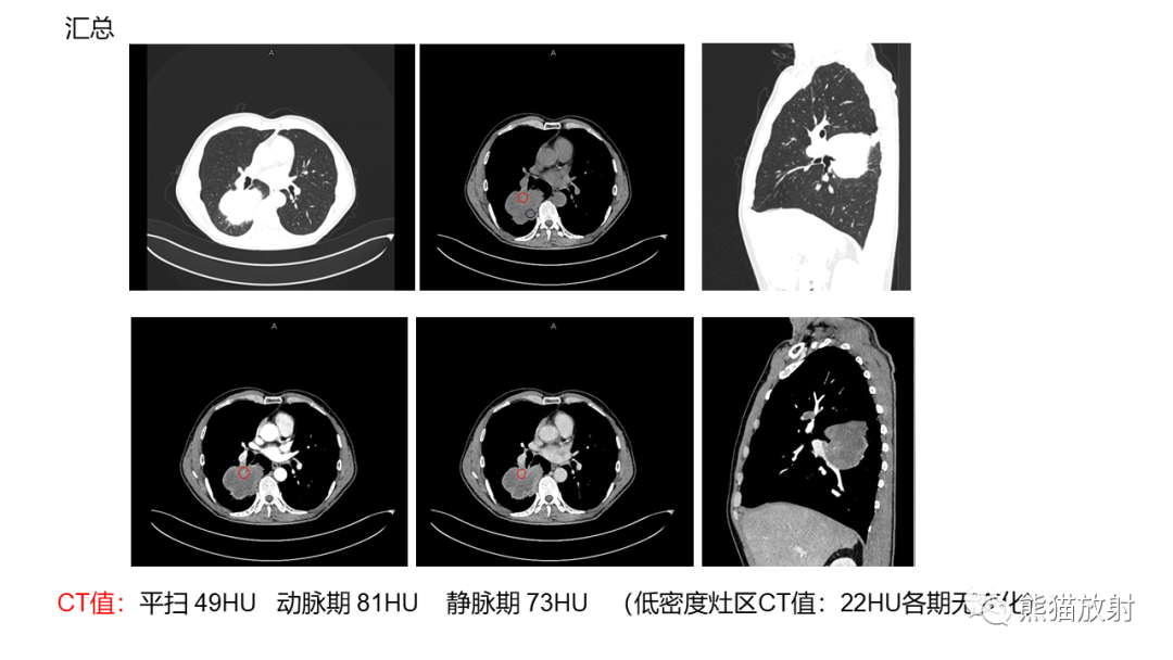 影像PPT - 【病例】肺大细胞神经内分泌癌2例CT影像-14