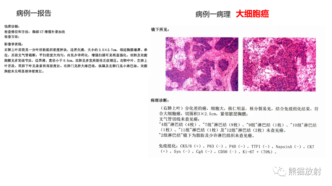 影像PPT - 【病例】肺大细胞神经内分泌癌2例CT影像-16