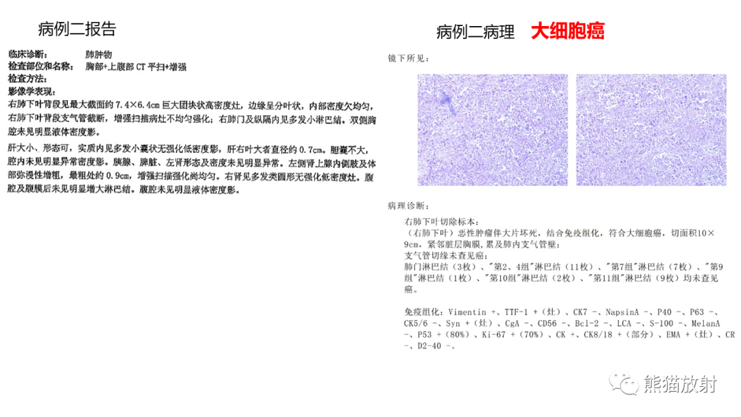 影像PPT - 【病例】肺大细胞神经内分泌癌2例CT影像-17