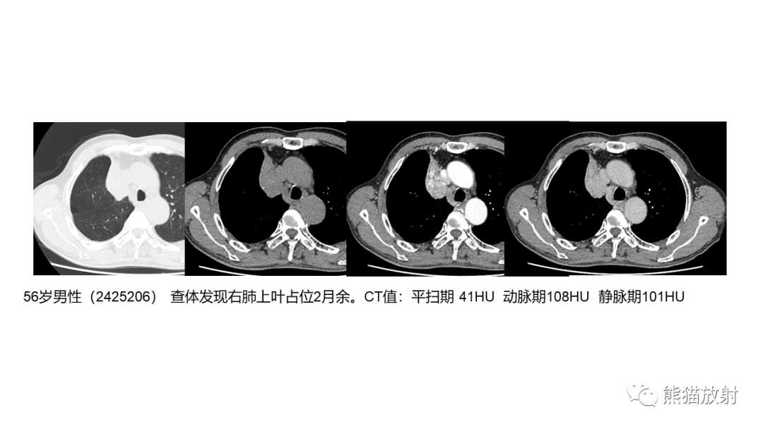 影像PPT - 【病例】肺大细胞神经内分泌癌2例CT影像-26