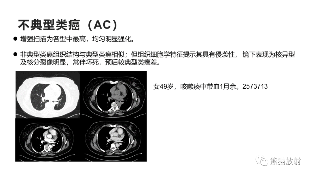 影像PPT - 【病例】肺大细胞神经内分泌癌2例CT影像-27