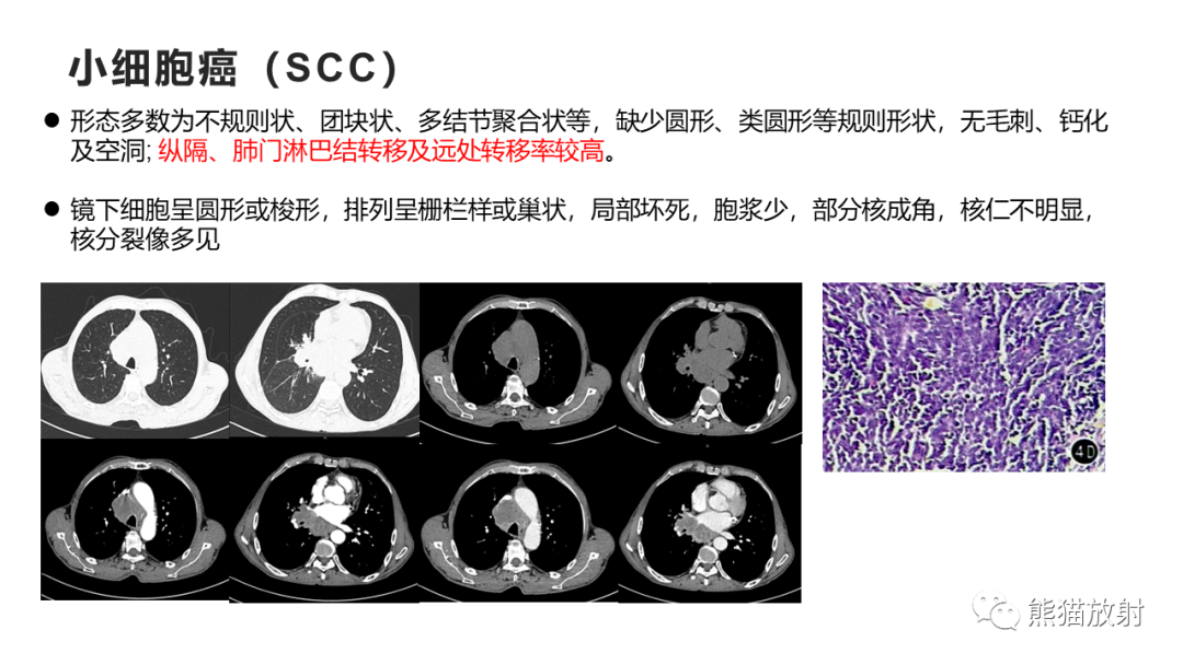 影像PPT - 【病例】肺大细胞神经内分泌癌2例CT影像-29