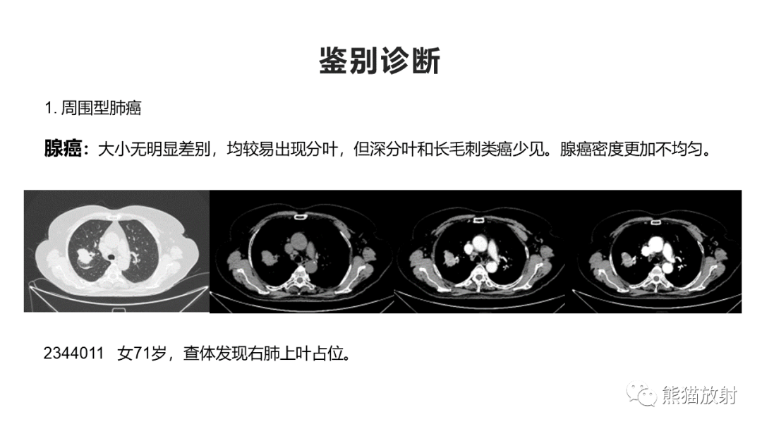 影像PPT - 【病例】肺大细胞神经内分泌癌2例CT影像-31
