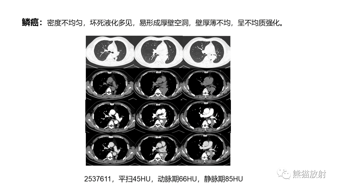影像PPT - 【病例】肺大细胞神经内分泌癌2例CT影像-32