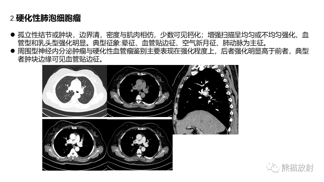 影像PPT - 【病例】肺大细胞神经内分泌癌2例CT影像-33