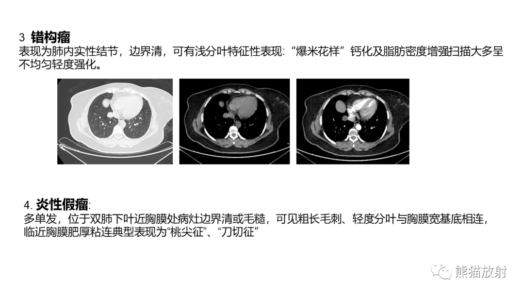 影像PPT - 【病例】肺大细胞神经内分泌癌2例CT影像-34