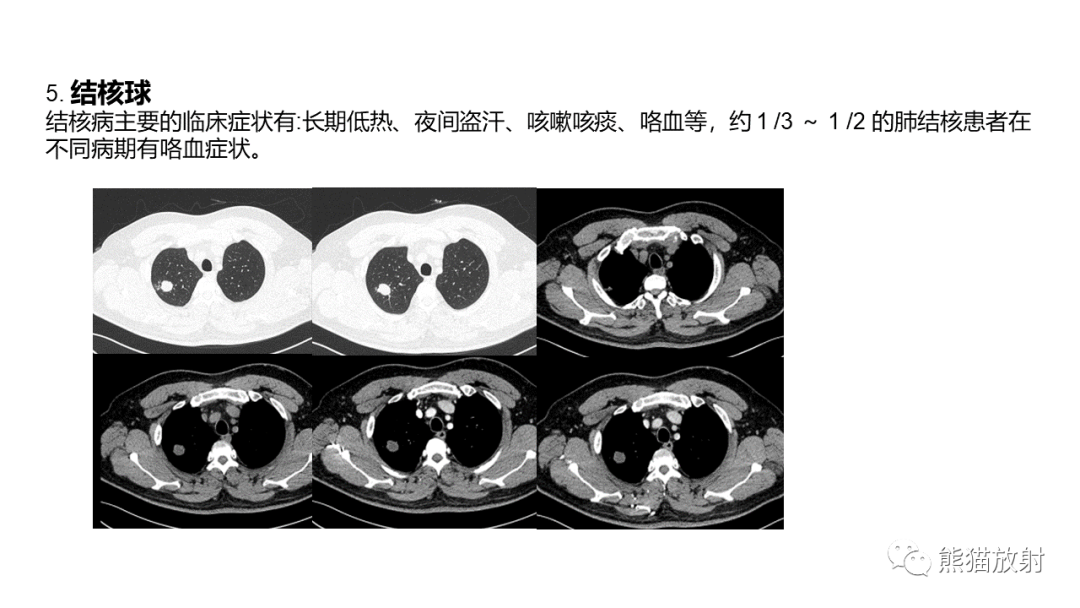 影像PPT - 【病例】肺大细胞神经内分泌癌2例CT影像-35