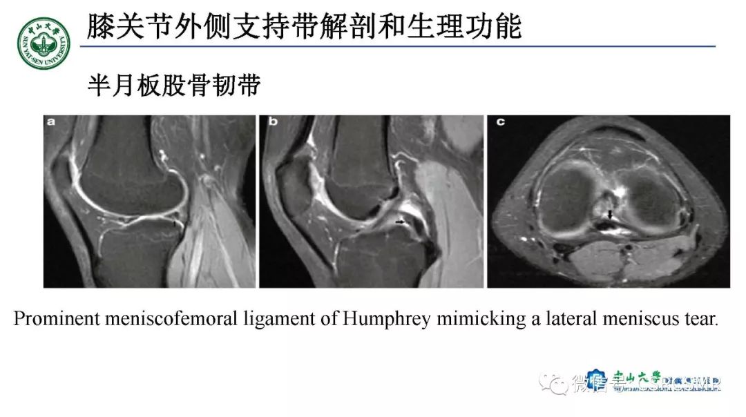 影像PPT - 【PPT】膝关节后外侧角区影像解剖及损伤后影像学诊断-12