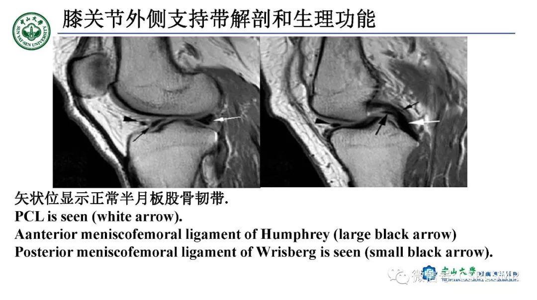 影像PPT - 【PPT】膝关节后外侧角区影像解剖及损伤后影像学诊断-13