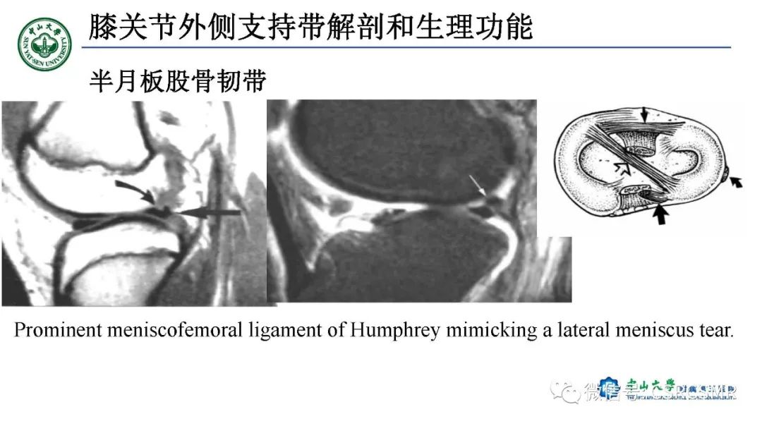 影像PPT - 【PPT】膝关节后外侧角区影像解剖及损伤后影像学诊断-14